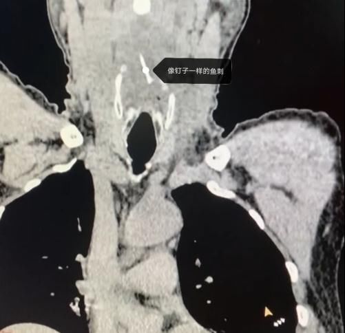 鱼刺卡喉|鱼刺卡喉用“老土方”？专家：不科学且危险！