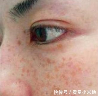 斑点|脸上长斑很难看?护肤达人教你祛斑秘籍,淡化斑点年轻十几岁
