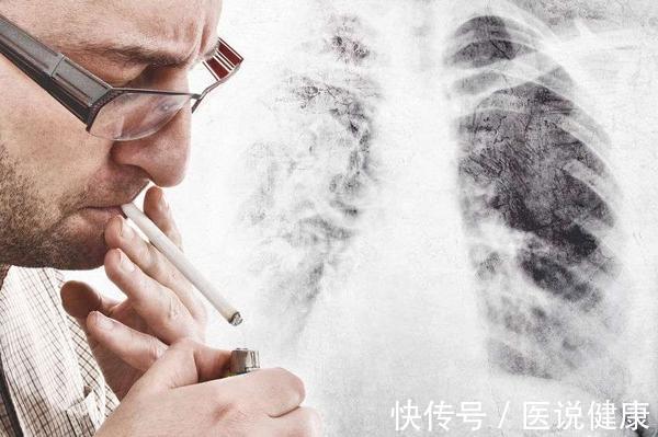 癌变|诱发肺癌的原因,不仅是抽烟!医生:这4点也是肺癌的相关因素