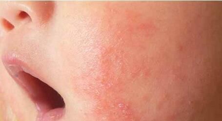 宝宝|宝宝湿疹影响孩子睡眠，这些方法，让孩子湿疹期间也能有好睡眠