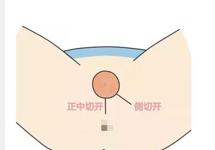 做好|明明是顺产，还要挨一刀，产科医生避免侧切，做好这5点很重要