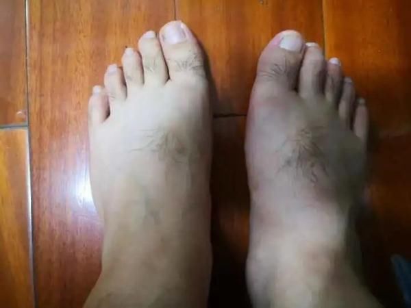 张霁|吃了3口大龙虾，杭州小伙痛到不能走路！很多年轻人中招！