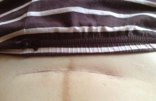 剖腹产|剖腹产一年后意外怀上了二胎，宝妈坚持不放弃，最终不幸离世