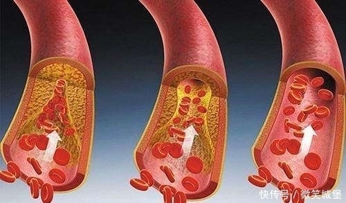 经常吃点这些“血管清道夫”食物，保证血管不堵塞，血液不粘稠