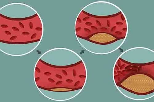 颈部|颈动脉彩超后，发现斑块，能按揉颈部吗？会引发斑块脱落吗？