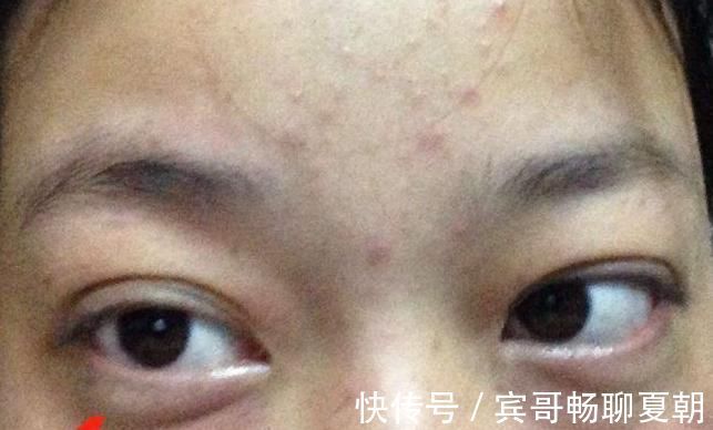 氣血|血脂高不高，看臉便知曉？臉上出現4大表現，要注意降低血脂了