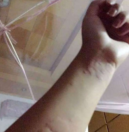 中药|七年荨麻疹,用一味中药就消了!我老师的“险招”值得研究