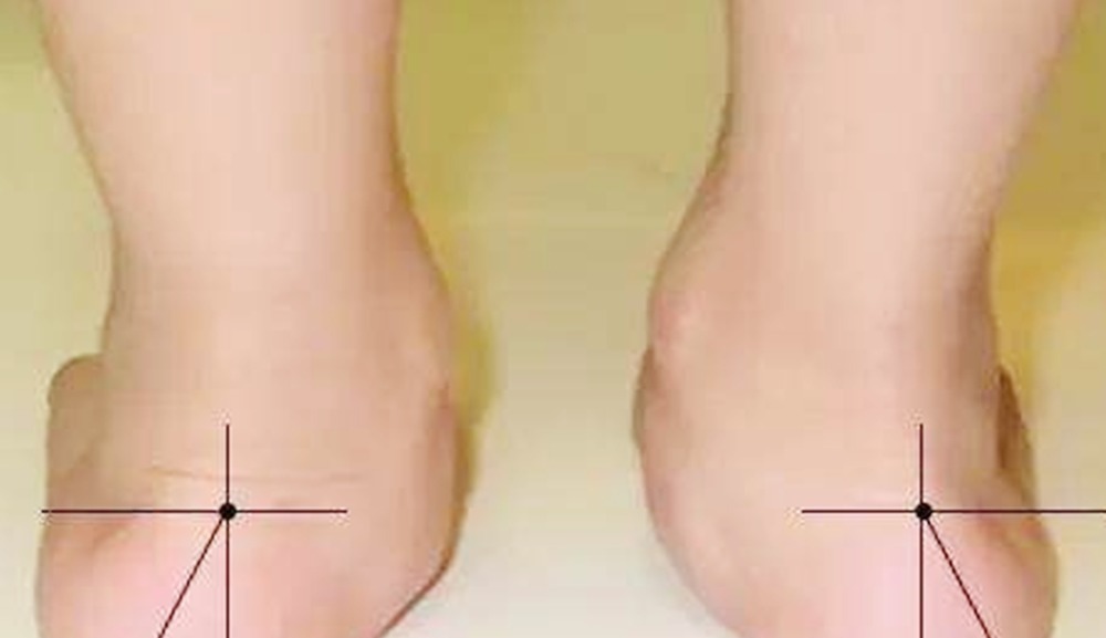 鞋子|4岁宝宝双脚变形,只因长时间穿这种鞋子,父母别不当回事