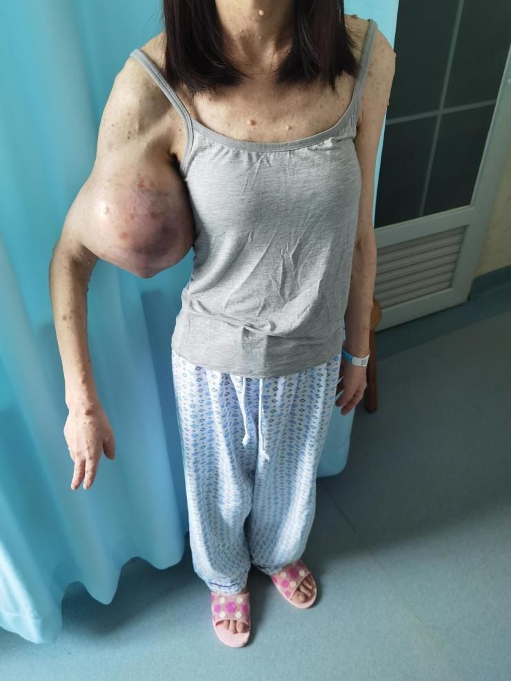 肿瘤|罕见！胳膊上长出排球大的肿瘤 医生成功完整切除