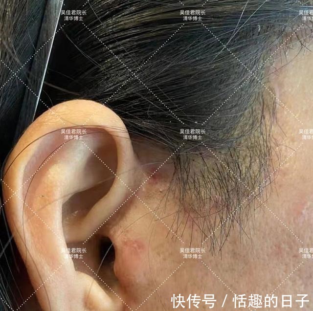 线雕 44岁小拉皮术后5个半月,用亲身经历谈一谈我的感受!