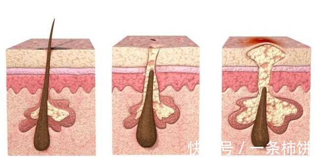 角质层|告别!九个闭口形成的原因!好皮肤才是仙女的本钱来一起变美吧