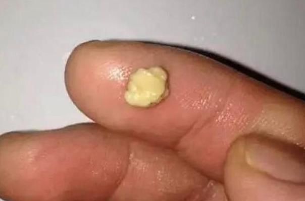 牙刷|女儿嘴太臭被同学孤立,医生从嘴里取出异物,连亲妈都当成作呕