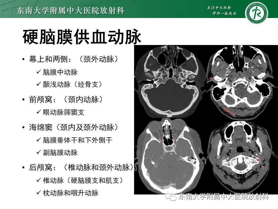 影像学|脑动静脉畸形影像学特征