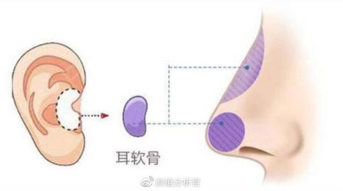 自体软骨隆鼻到底用肋骨鼻好还是耳软骨好呢？哪个效果好？