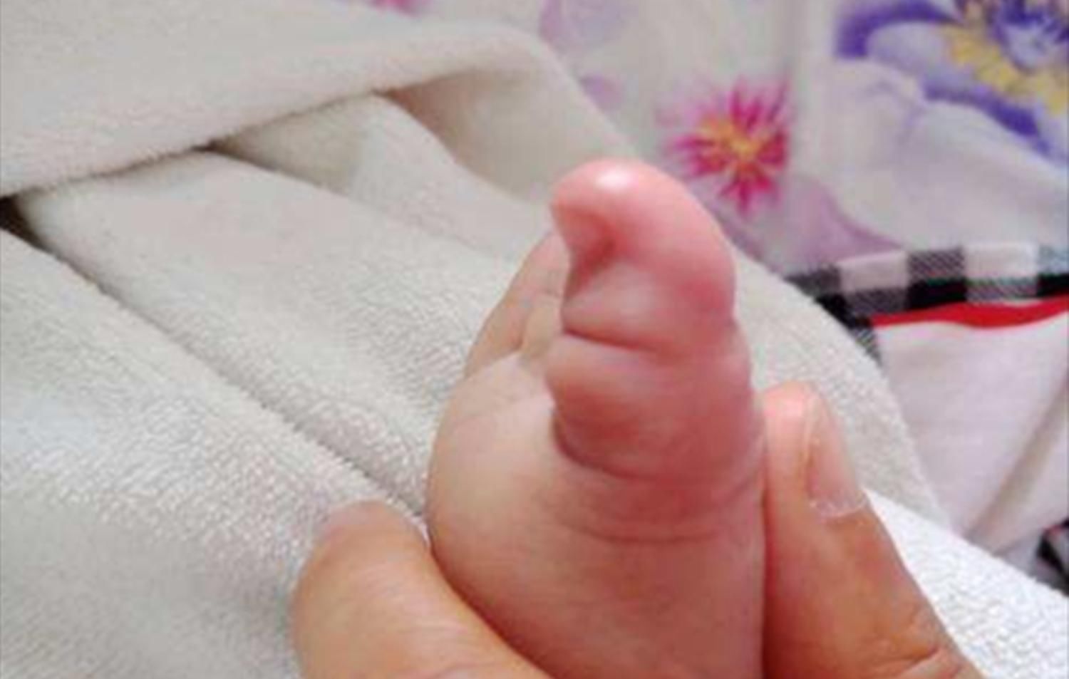 豆豆|4岁娃双脚变形,因妈妈长时间给他穿这种鞋子,可别不当回事