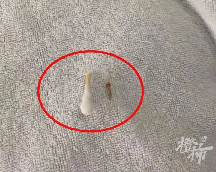 骨头|危险！一碗鸡汤，怎么就喝出了一台全麻插管手术？