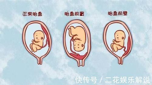 胎儿|胎儿前壁好还是后壁好,胎盘前壁优劣势各有两点,孕早期早知道