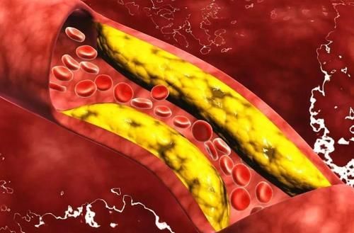 小事|血脂“发物”是面条？想要降脂，做好这几件小事，或是关键