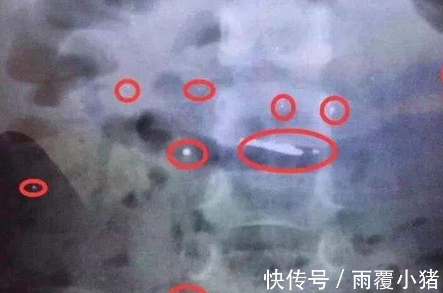 韭菜|3岁女儿误吞水银,奶奶坚持吃完韭菜再去医院,医生点赞做法高明