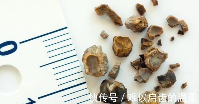 医生|切除胆囊，对身体有什么影响吗医生终于讲出大实话