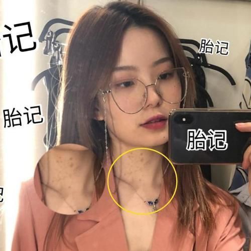 包容度|被“胎记”耽误前程的明星，陈卓璇能用粉底遮盖，他却令人可惜