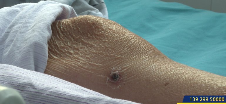 王妍|女子呼吸衰竭至今仍住ICU！罪魁祸首令人心惊