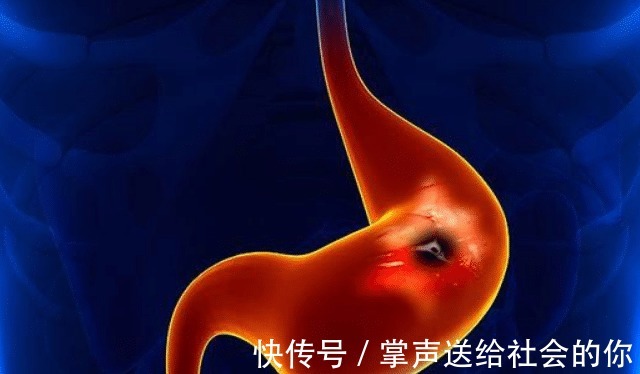 食物|大便不成形现象,就是肠胃炎还可能是这5种疾病!