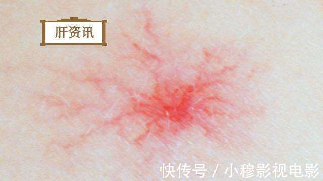 肝腹水|早期肝硬化可逆转,身上长出这些,抓住治疗黄金期,肝硬化好一半