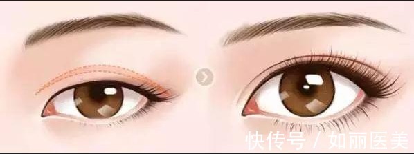 重睑 影响双眼皮手术效果的因素有哪些?