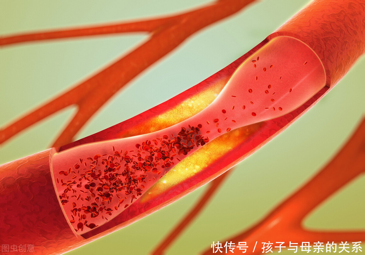 血脂|内科医生提醒:3件事坚持2个月,血管通透,血脂降了,头也不晕了