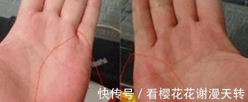 信号|肝硬化前有2个“危险信号”，肝不好及时自查，降低风险