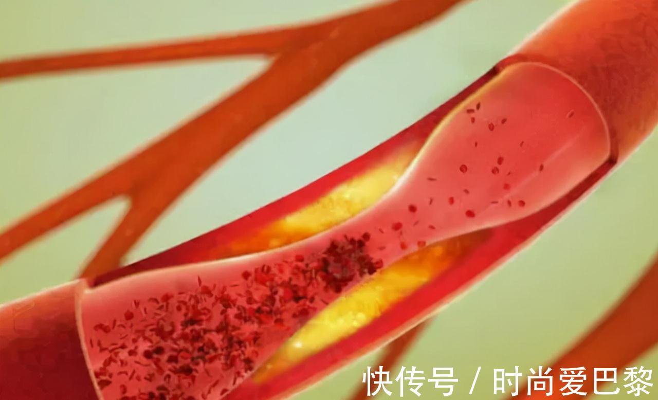 冠状动脉|多走路能降血脂？医生提醒：日常多吃这4物，或比走路效果好