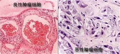 误诊|肿瘤一般治不好，能治好的都是误诊了？肿瘤医生说出了心里话