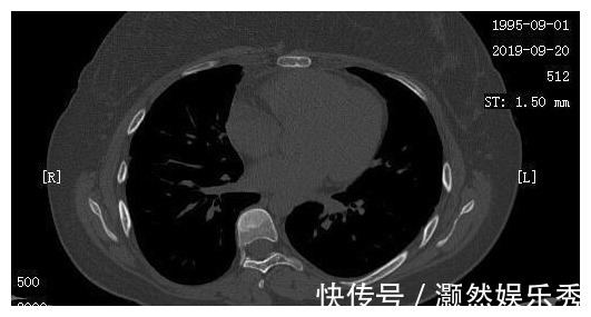 癌细胞|23岁女孩癌细胞全身扩散，一年抗癌出奇迹