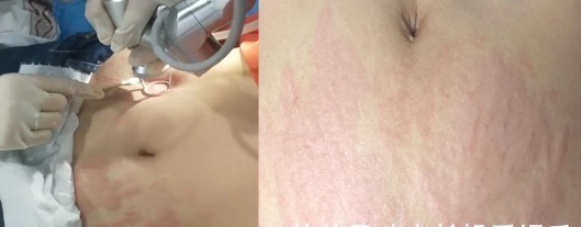 精华乳|生个孩子“肚皮开花”,孕期做好掌握这3点,妊娠纹离你远远的