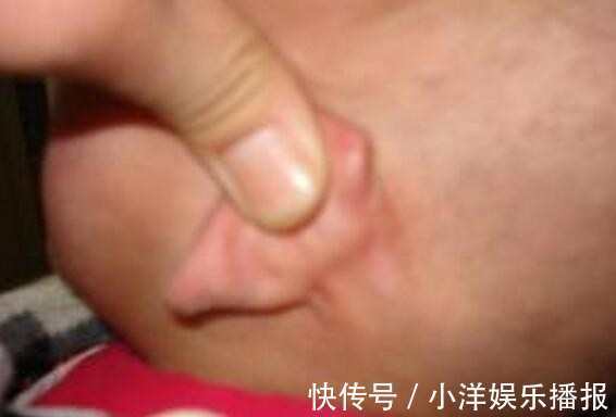 症状|身上出现以下症状是肠癌，却被误认为是痔疮，及早治疗