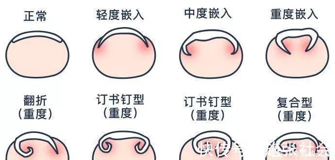 趾甲|给婴幼儿剪指甲可不简单, 我的孩子被剪成了甲沟炎