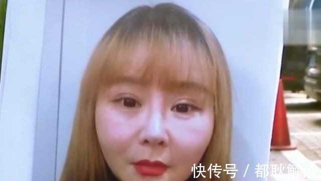 整形 女子花1万3做面部埋线,术后变成“大饼脸”,美颜都救不回来