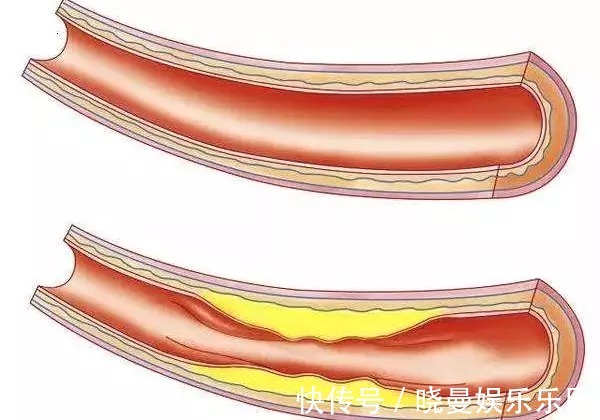 动脉硬化|血管开始变硬，腿脚先知道？若占3个以上表现，尽快去医院检查