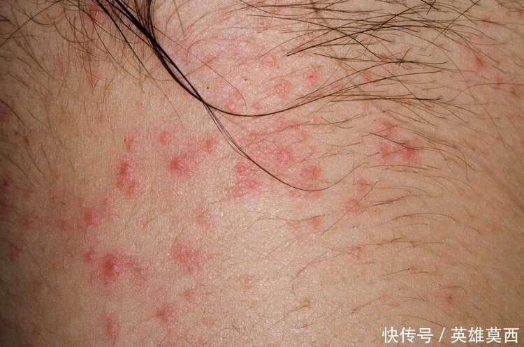 发作|湿疹反复发作奇痒难耐中医给出两种治疗方法,可有效止痒治湿疹