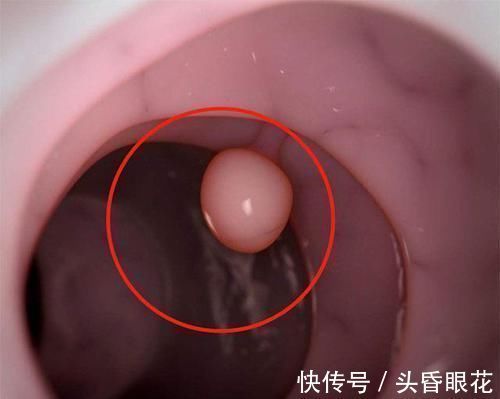 乳腺结节|离癌还远的，身上有没有4个“小突起”，占一个也好，你了占几个