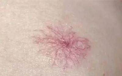 青年|28岁青年因“节俭”患上肝癌，医生建议要留意5个报警信号