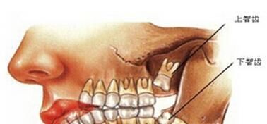 智齿|智齿是人体正常的结构吗一定要拔掉它吗