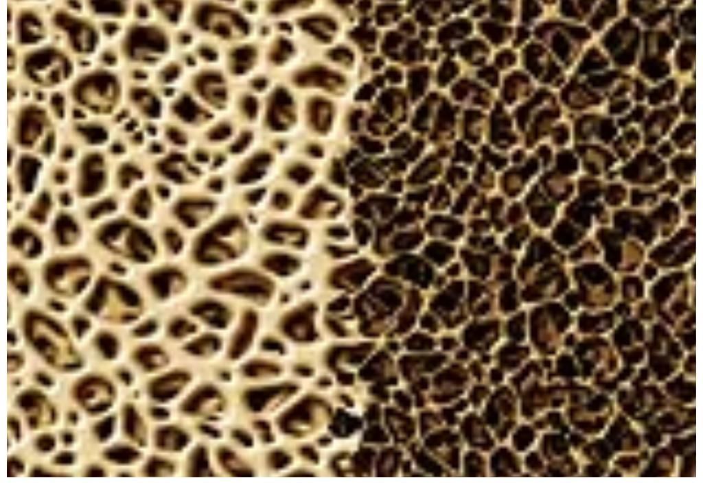 骨质疏松|骨质疏松是花生吃多了?72岁徐院士:想要骨头好,少吃2种食物