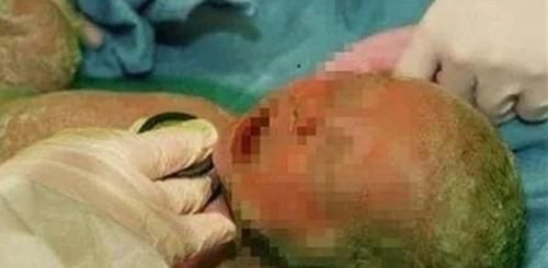孕妇|高龄孕妇37周腹痛难忍，剖腹产下“绿宝宝”，医生怒斥：太无知