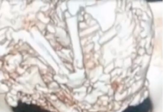 妈妈|“婴儿”在肚子里一住就是61年!妈妈91岁了才被发现,伤心欲绝