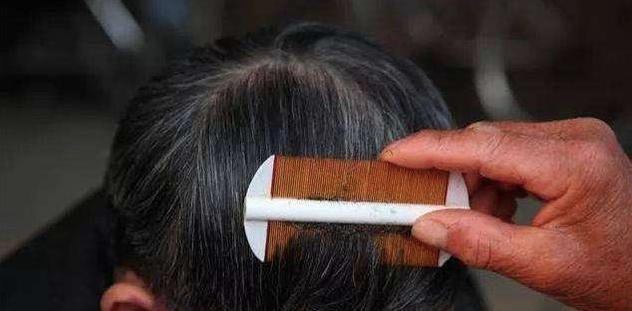 为何30年前农村几乎男女都有虱子，现在怎么没了虱子是哪来的