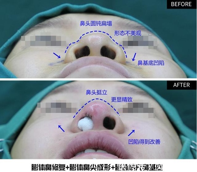 颌面 “鼻基底填充”不能和“隆鼻手术”一起做?听听整形医生怎么说