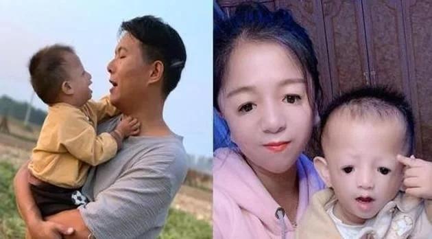 王女士|还记得那个25岁的“鸟脸妈妈”吗?孩子不幸遗传疾病,如今怎样