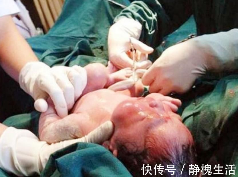 脚心|新生儿宝宝哇哇哭,是因为剪脐带痛吗?医生弹了下宝宝脚心笑了